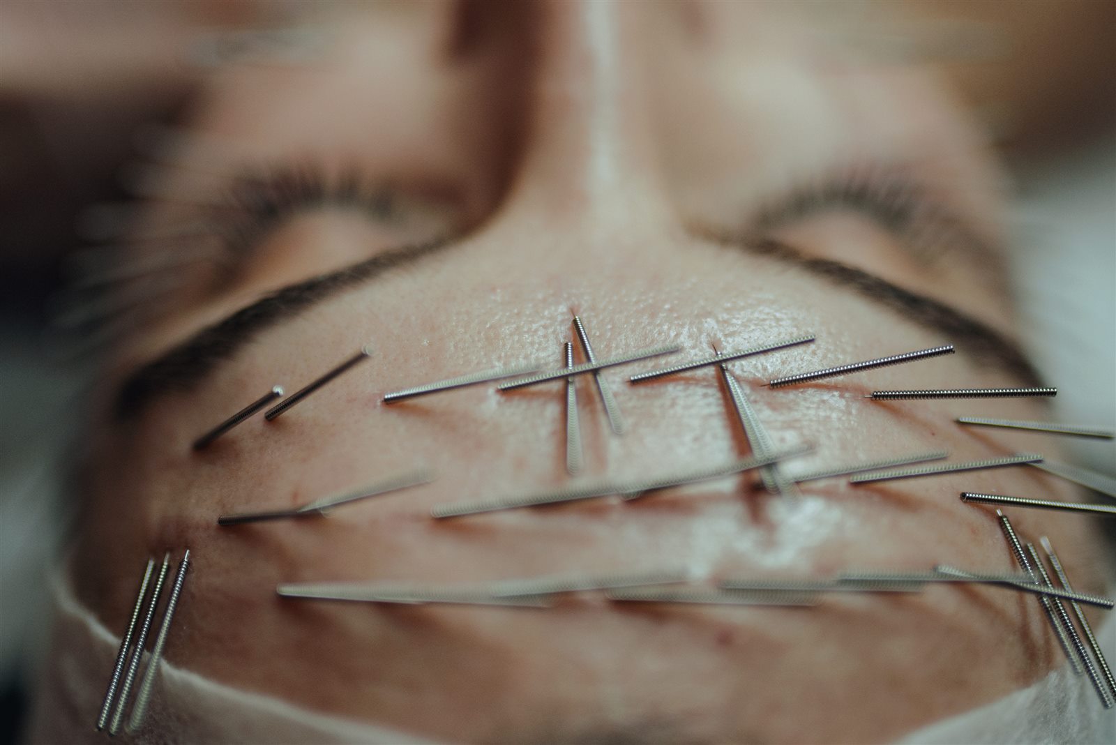 Igły spiralne w skórze czoła podczas zabiegu Needle Shaping — tworzenie nici autologicznych